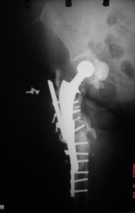 περιπροθετικά κατάγματα