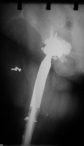 περιπροθετικά κατάγματα