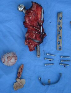 περιπροθετικά κατάγματα