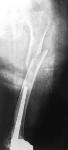 περιπροθετικά κατάγματα