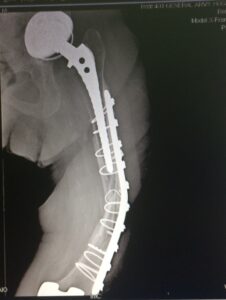 περιπροθετικά κατάγματα