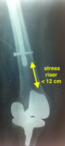 περιπροθετικά κατάγματα