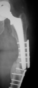 περιπροθετικά κατάγματα